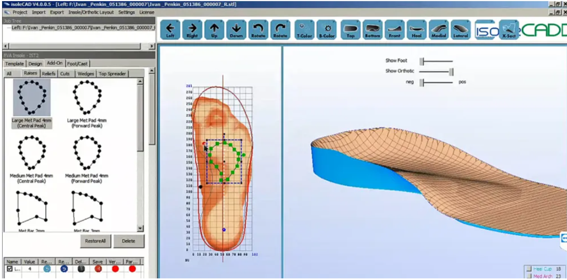 3D-печать ортопедических стелек