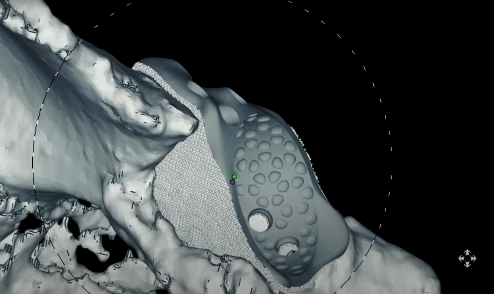 3D модель импланта